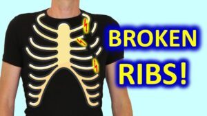 Do’s & Don’ts To Recover From Broken Ribs