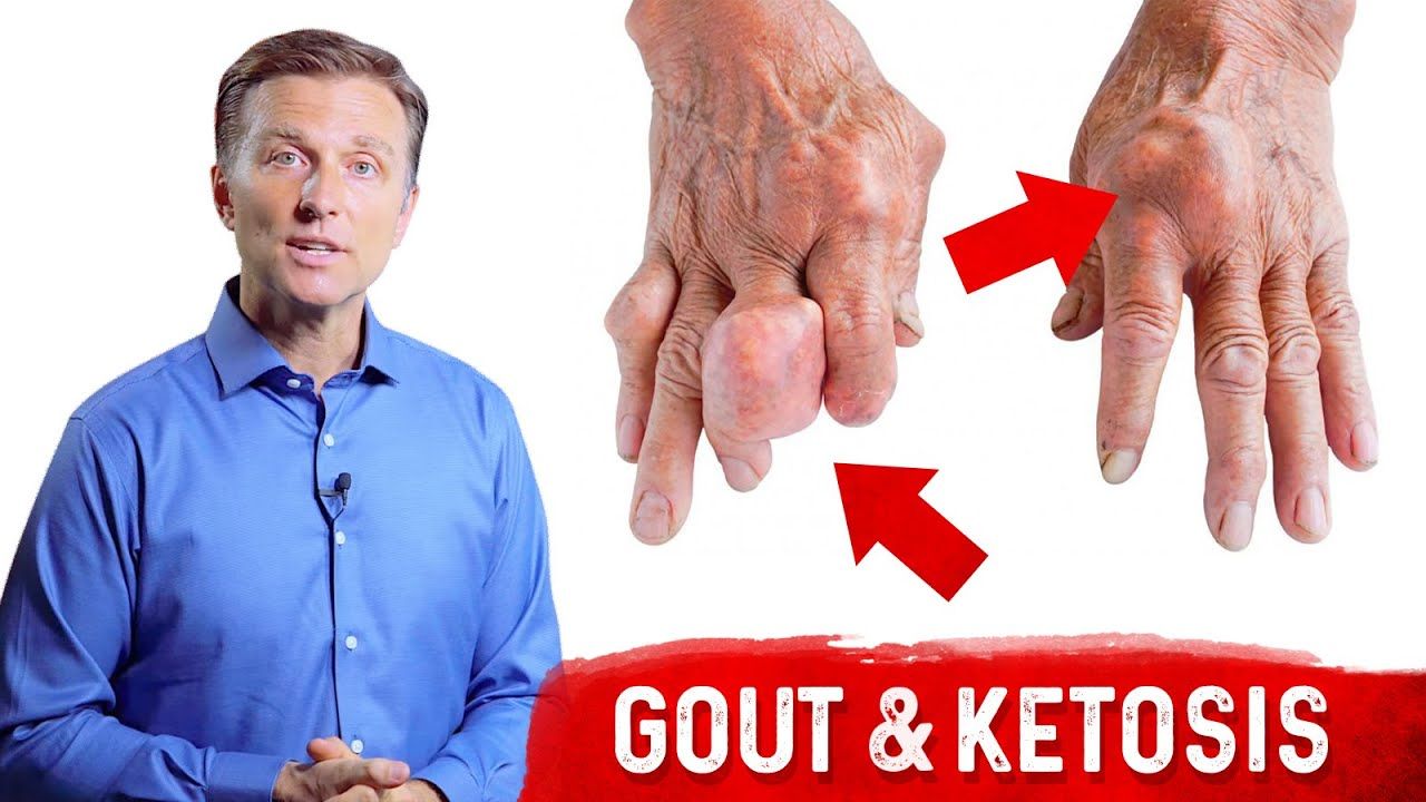 Gout & Ketosis – Uric Acid Stones & High Uric