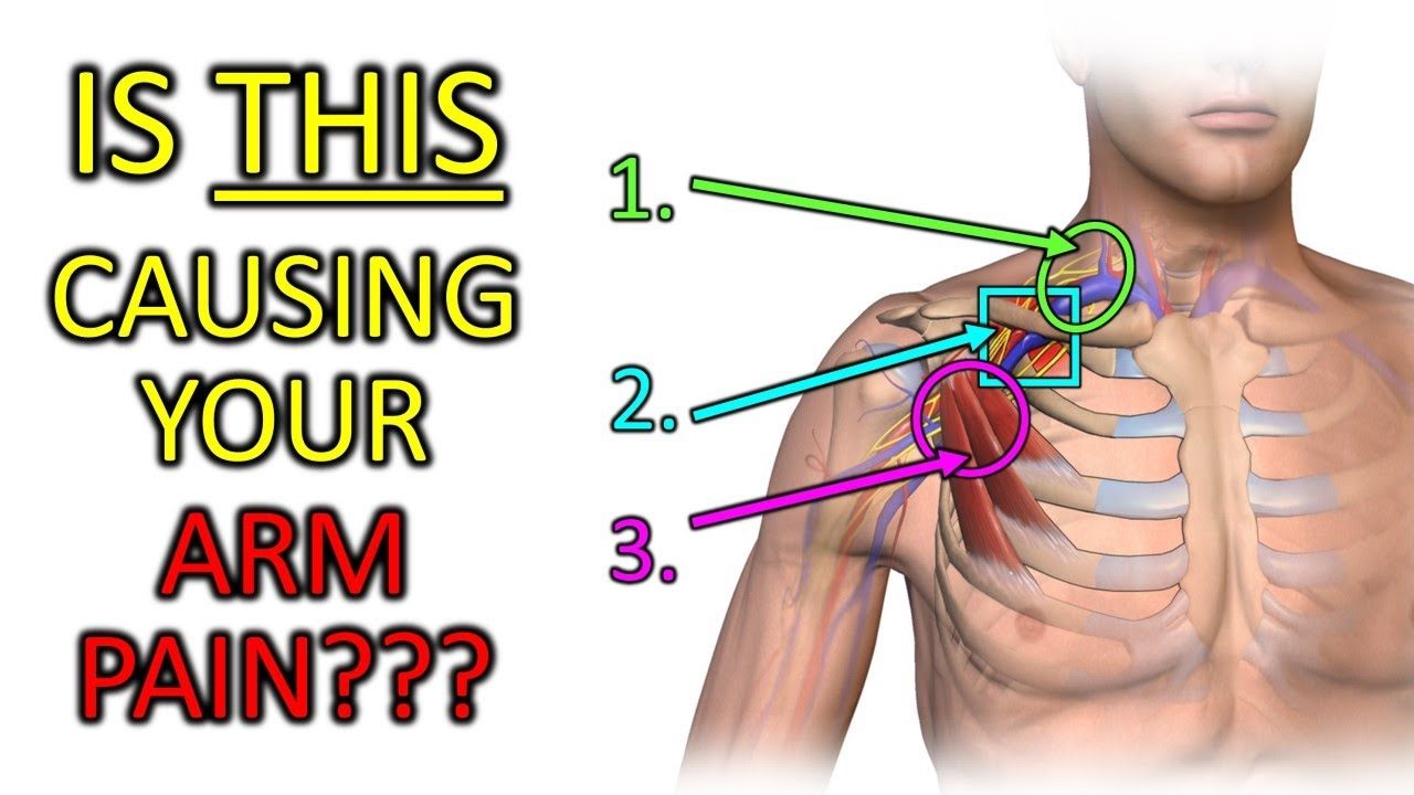 Fix Thoracic Outlet Syndrome: Is This Causing Your Arm Pain